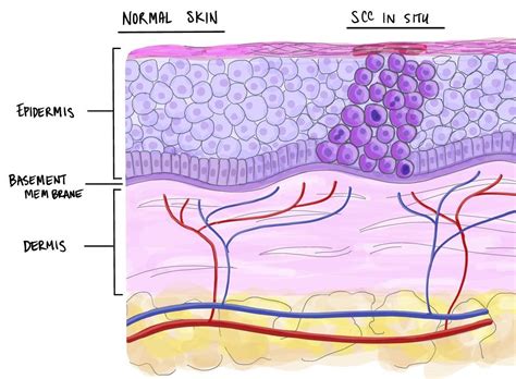 Squamous Cell Carcinoma In Situ Of The Skin MyPathologyReport Ca