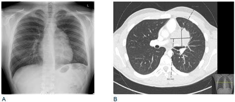 Ijms Free Full Text Recurrence Of A Mediastinal Germ Cell Tumor As