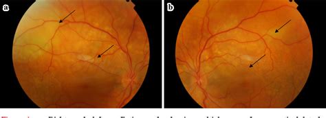 Serous Retinal Detachment Oct