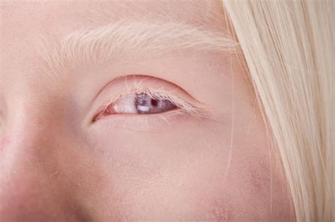 Premium Photo Albino Woman With Blue Eyes