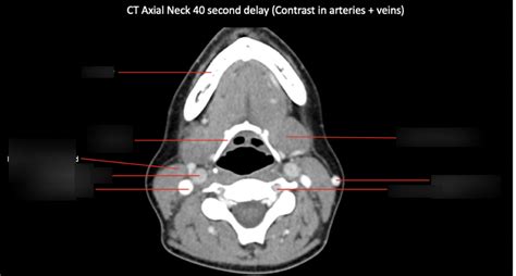 CT scan of brain Diagram | Quizlet