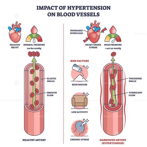 impact  hypertension  blood vessels  high pressure outline diagram vectormine