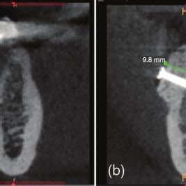 A Preoperative CBCT B 6 Months Post Operatively CBCT Showing