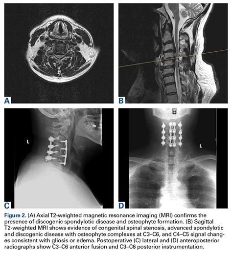 Combined Anterior Posterior Decompression And Fusion For Cervical