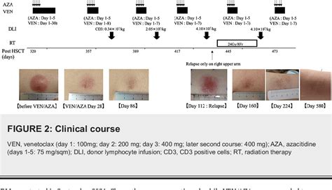 Figure From Successful Treatment With Venetoclax Plus Azacytidine