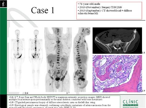 Osteosclerotic Bone Metastases From Gastric Adenocarcinoma Imaging