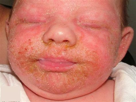 Eczema And Atopic Dermatitis Rashes Causes Symptoms