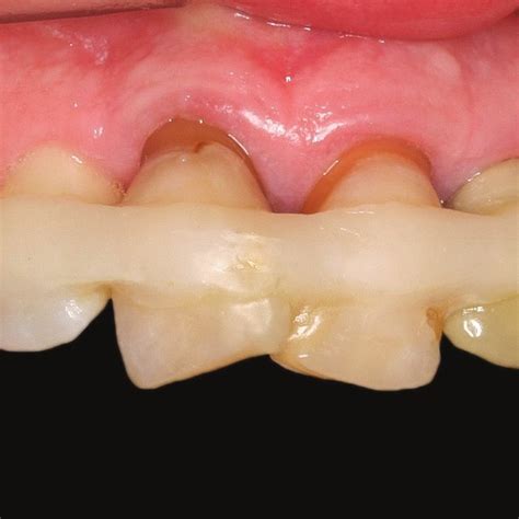 Initial Frontal View Of The Maxillary Dental Arch Showing Splinted And