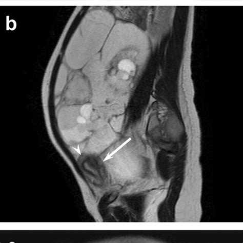 A Year Old Female With Mucinous Borderline Tumor A Sagittal