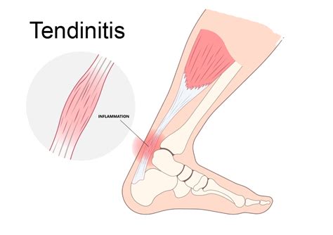 What Is Tendinitis Tendonitis Symptoms And Causes