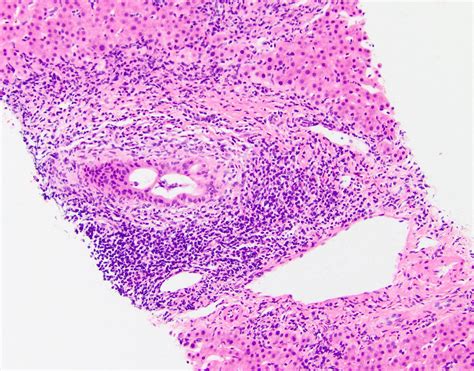 Pathology Outlines Primary Sclerosing Cholangitis