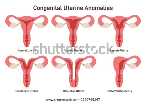 Congenital Uterine Anomalies Set Female Reproductive Stock Vector
