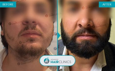Fue Beard Transplant Advanced Hair Clinics