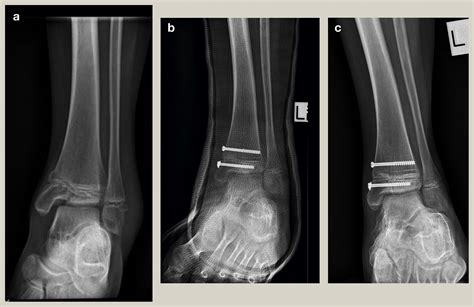 Fractures Of The Distal Tibial Physis Orthopaedics And Trauma