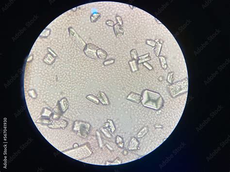 Microscopic view of struvite crystals from urinary sediment. Magnesium ammonium phospate ...