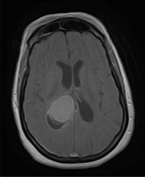 Mri Brain With Contrast Axial View Shows A 3 Cm Cystic Lesion In The