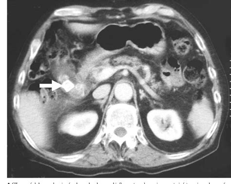 Figure 2 From Small Bowel Obstruction Caused By Intraluminal Migration