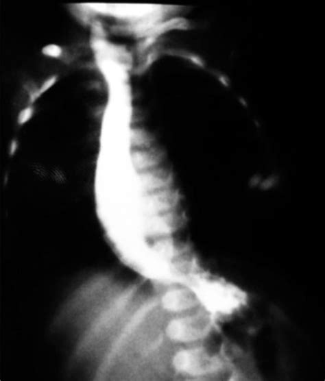 infantile achalasia cardia