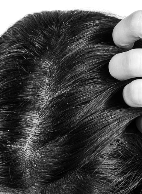 Everything you need to know about keratosis pilaris of the scalp.