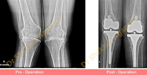 Primary Complex Total Knee Replacement ( Valgus Knee ) | Sant Parmanand ...