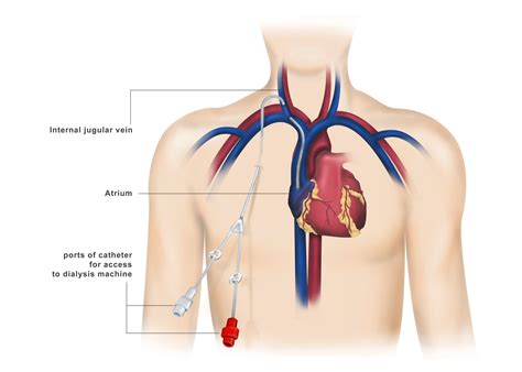 Dialysis Catheter Size at James Schofield blog