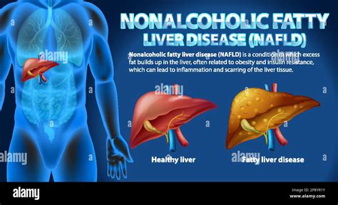 Enfermedad del hígado graso no alcohólico NAFLD ilustración Imagen