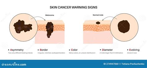 Melanoma Warning Signs Vector Illustration Cartoondealer