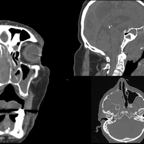 Surgical Resection Of The Tumor By Mid Face Degloving Approach