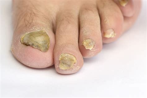 What is a Toenail Fungal Infection? - Walkrite Foot Clinic