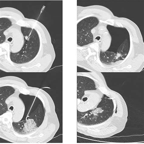 Ct Guided Transthoracic Needle Biopsy From A Lesion In Left Lungs Upper Download Scientific