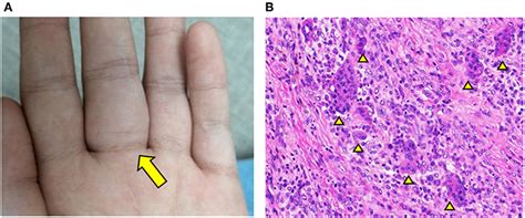 Giant Cell Tumor Of Tendon Sheath