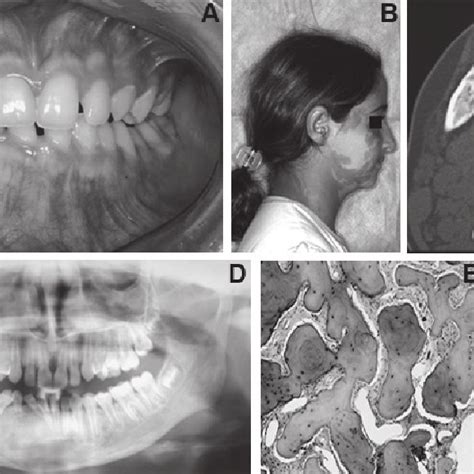 Fibrous Dysplasia Fd And Mccune Albright Syndrome Case A Facial