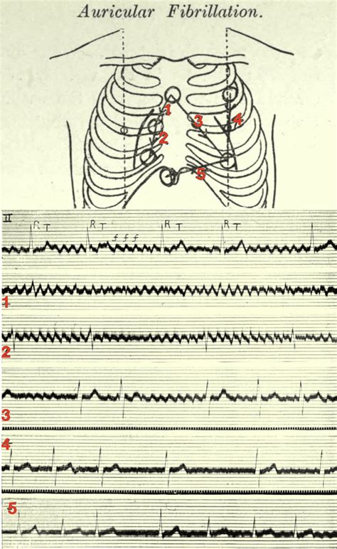 Lewis lead • LITFL • Medical Eponym Library