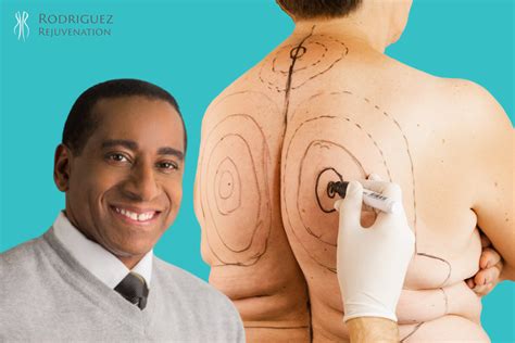 Understanding Liposuction Revision Procedure Insights