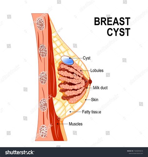 Ilustrasi Stok Breast Cyst Crosssection Mammary Gland Fluidfilled