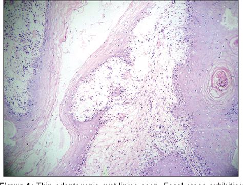 Primary Intraosseous Squamous Cell Carcinoma Derived From Keratocystic