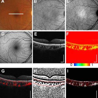 Ps Oct Imaging From The Left Eye Of A Year Old Female From The