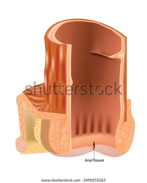Anal Fissure Cross Section Rectum Coloproctology Stock Vector Royalty Free