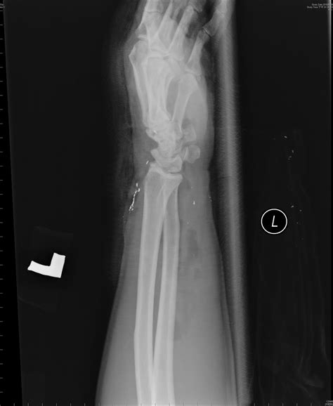 Big Bad Ulnar Styloid Process Fracture And Lateral Column Fracture