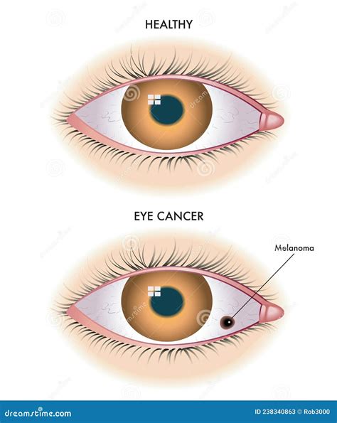 Gesundes Auge und Melanom vektor abbildung. Illustration von krebs