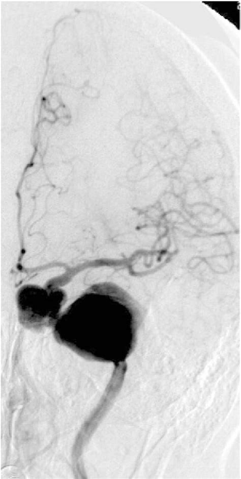 Figure From The Underlying Mechanisms Of Endovascular Exclusion Of