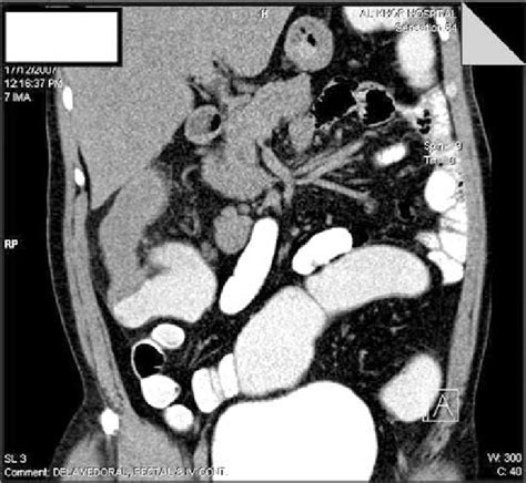 Abdominal Ct With Contrast Showing The Appendicular Mass Download Scientific Diagram