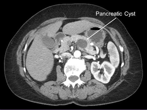Global Study Of Pancreatic Cancer Offers Possible Insights Into