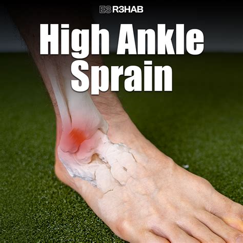 high ankle sprain  rehab
