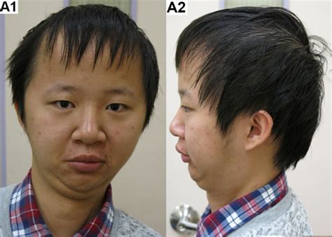 Figure 1 Craniofacial Features Of An Individual Genereviews