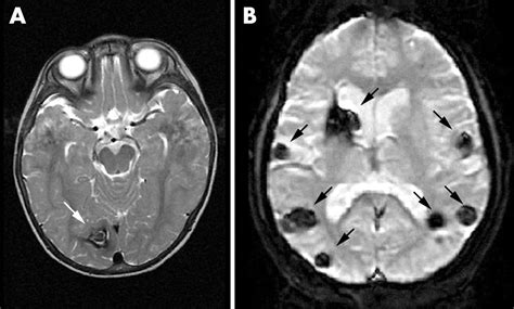 Disease Of The Week Cerebral Cavernous Malformations Ucsd Guardian