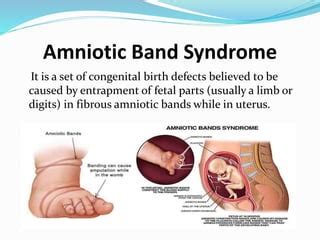 Amniotic Band Syndrom Epptx Ppt