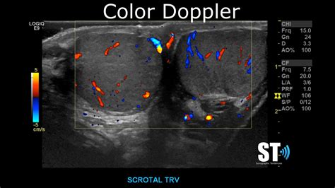 Testicular Scrotal Doppler Protocol Sonographic Tendencies