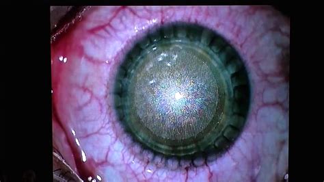 Роговичная хирургическая коррекция миопии и сложного миопического ...