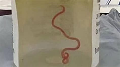 Doctors Find Wriggling Parasitic Worm Living In Woman S Brain In World